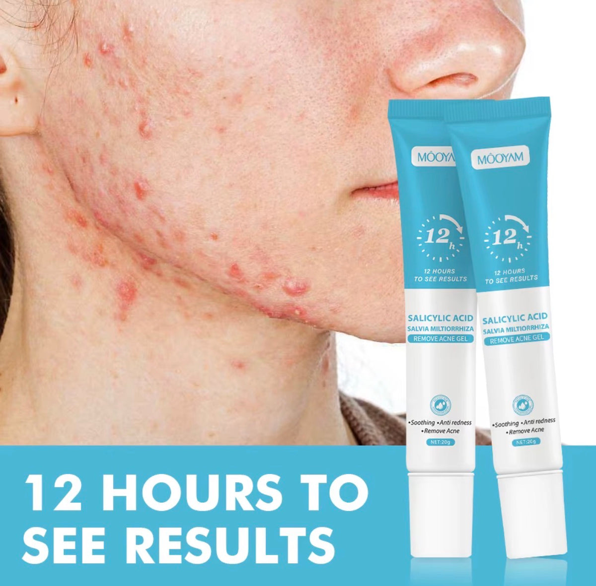 Super Gel Anti-Acné MOOYAM Acide Salicylique Salvia
Miltiorrhiza, Élimination de l'Acné, Dissolution des Impuretés, Désincrustation Profonde des Pores, Nettoyage en Profondeur, 20g

⭐️⭐️⭐️⭐️• 15640 vendus